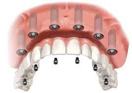 all-on-six-implant